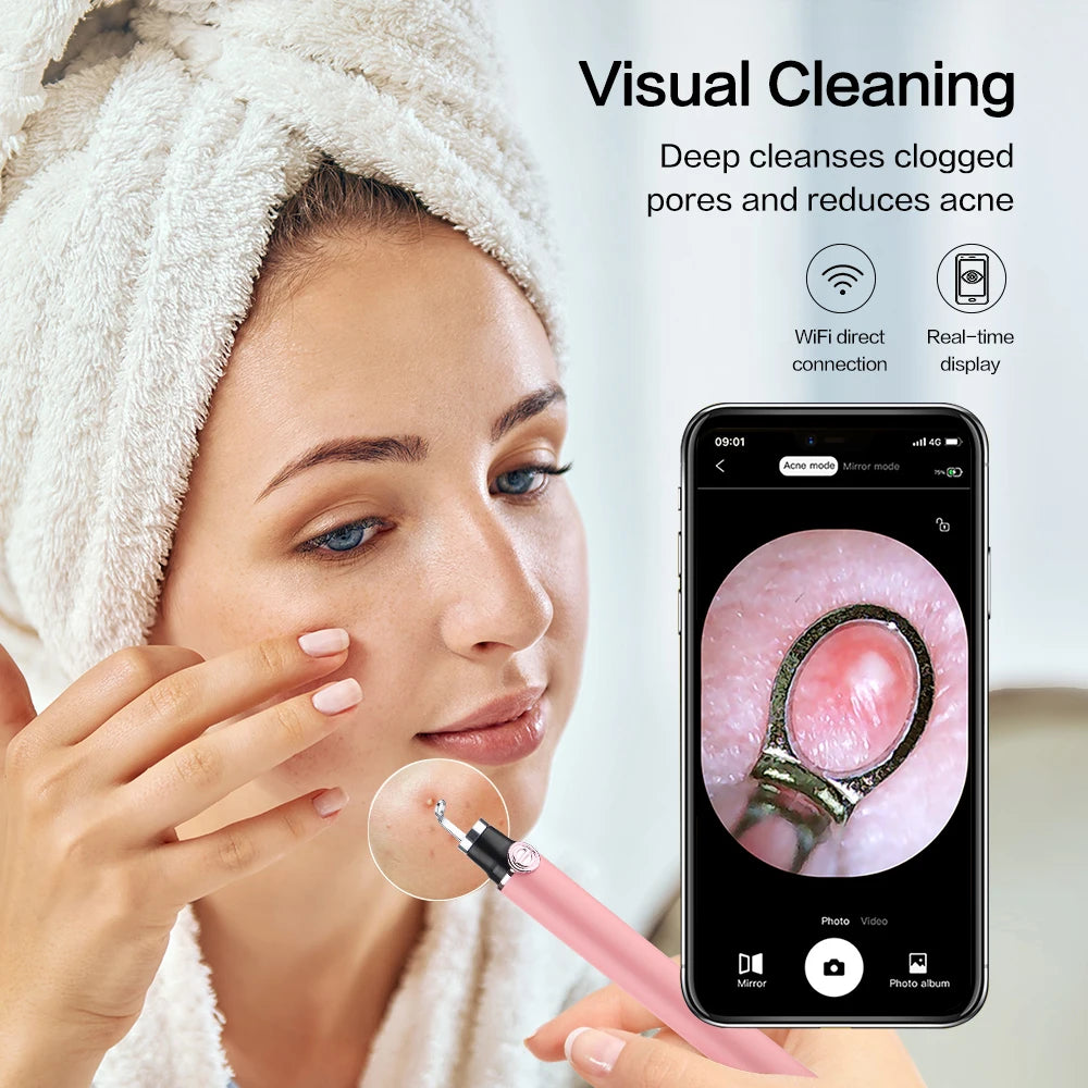 Smart Visual Acne/ Blackhead Remover